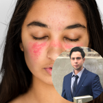 Lupus Erythematosus & Sjogren Syndrome